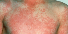 Advice if you’re concerned about scarlet fever